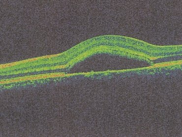 Corneal Abscess